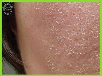 ハーブピーリング 名古屋/ハーブピーリング