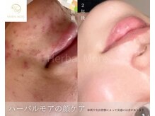 互恵/ニキビ肌も綺麗に
