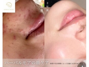 互恵/ニキビ肌も綺麗に
