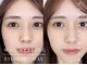 眉毛アイブロウサロン&α横浜店 眉毛サロン/眉毛/アイブロウ/まゆげ/眉毛間引き/眉毛の写真/【眉毛サロン】眉毛だけでなく顔全体WAX脱毛◎眉毛を整え産毛のない,すっぴん美人へ♪美眉/眉毛/アイブロウ