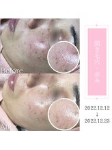 ベストベル(BestBelle)/毛穴悩みの方はマイクロニードル