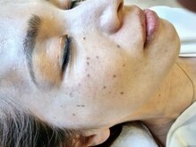 リセル(RE.cell)/シミケア施術直後