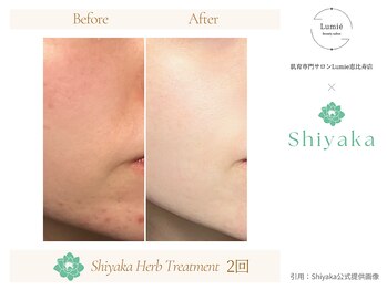 ルミエ 恵比寿店(Lumie)/ハーブピーリング症例
