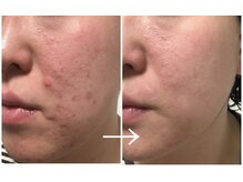 エミナル(eminal)/ビフォーアフター/ニキビ/梅田