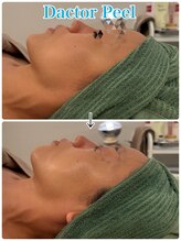 ネオズエゴ アーチ(neos ego Archi)/ダクトピール　ビフォーアフター