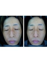 ザ フェース 京都御池店(THE FAITH)/お客様のお肌変化