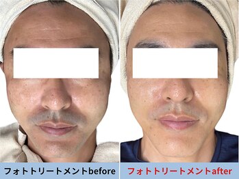 ミスターアンクール 鹿児島(Mr.uncoeur)/フォトトリートメント