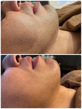 メンズ脱毛マックス 大宮店(MAX)/ヒゲ脱毛のビフォーアフター