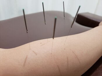 アラキ(ARAKI)/指が痛い、ばねゆびに鍼灸施術