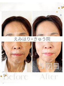 えみはりきゅう院/エラ張りもスッキリ♪