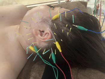 瑞 鍼灸院/頭皮鍼+美容鍼