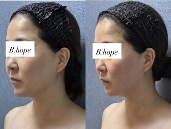 ビーホープ(B.hope)/30代モニター様2回目