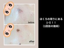 ベリル(BERYL)/魔法のシミとり　施術1回目