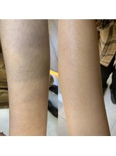 リ シャルム(Re Charme)/腕の毛も！うぶ毛にも！