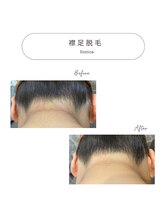 スターチス(Statice)/襟足脱毛　ビフォーアフター