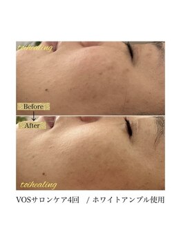トワヒーリング(toihealing)/肌質改善/VOSサロンケア