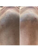 エピシアドットエヌ(epicia.N)/ヒゲ脱毛☆途中経過