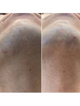 エピシアドットエヌ(epicia.N)/ヒゲ脱毛☆途中経過