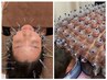 【美容鍼＋無数のカッピング(うつ伏せのみ)】　3週に１回が◎