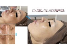 ファルファラ(farfara)/天然ハーブピーリング