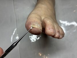 痛かった巻き爪が改善