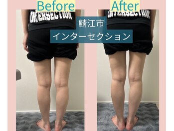 腰の整体インターセクション/美容整体　腹圧調整で骨盤が安定
