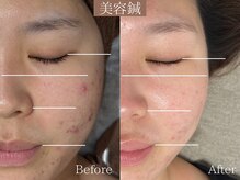 ひじ鍼灸整骨院