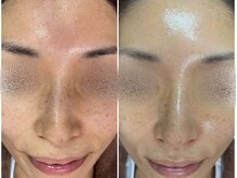 毛穴ピーリングケア＆小顔専門サロン　R.a【アルエ】/ツヤ肌ラミネーションピーリング