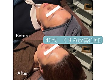 ウル(ulu)/無針水光注入
