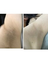 ナノハナ/鹿沼市の全身脱毛のナノハナ