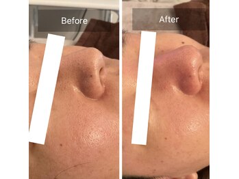 リュミエール デスポワール(Lumiere d'espoir)/毛穴洗浄