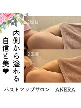 アネラ(ANERA) 心斎橋/20代バストアップビフォアフ症例