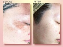 ジュリア オージェ 四条河原町店/ ビフォーアフター（シミケアP）