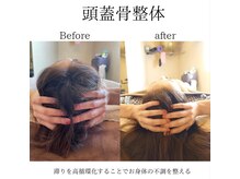 RKY/頭蓋骨矯正で頭の歪み改善