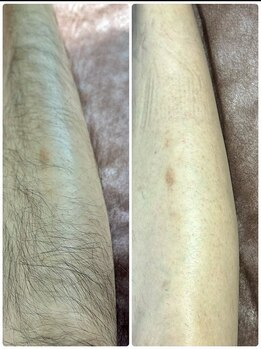 ジョルフ サロン オリジナル(JOLF salon original)/夏に向けて大人気★メンズ足脱毛