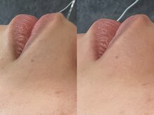 ウー(Wu)/wax脱毛(口周り)