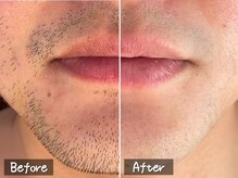 ココモンド(COCOMONDO)/顔脱毛/ヒゲ脱毛/メンズ脱毛