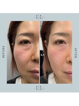 ラプティット(La petite)/50代女性/1回の変化