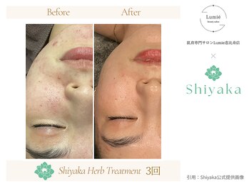 ルミエ 恵比寿店(Lumie)/ハーブピーリング症例
