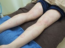 すずらん接骨院/吸い玉　脚