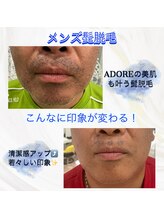 アドア(ADORE)/【メンズお髭脱毛】経過写真