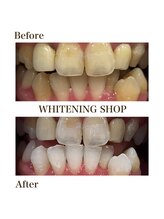 ホワイトニングショップ 岩出店(WHITENINGSHOP)/フリーパスBefore/After