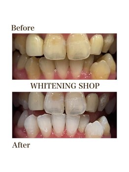 ホワイトニングショップ 岩出店(WHITENINGSHOP)/フリーパスBefore/After