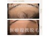 【9周年キャンペーン】お顔脱毛2回コース　5500円　【医療提携脱毛】