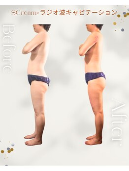 櫻陽(Ouyou)/脂肪燃焼クリーム×120分コース