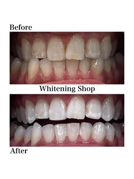 ホワイトニングショップ 新宿店/【ホワイトニング】BeforeAfter