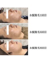 ホッコリ 段原店(HOKKORI)/人気No.1！ヒゲ脱毛♪