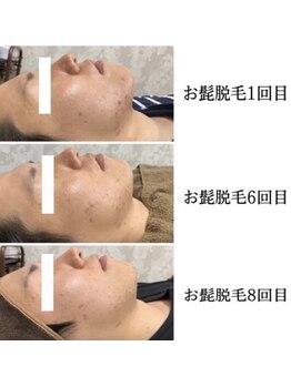 ホッコリ 段原店(HOKKORI)/人気No.1！ヒゲ脱毛♪