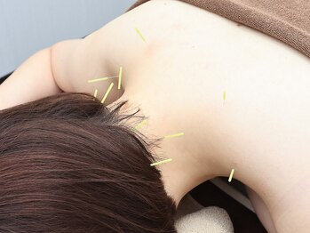 いおり鍼灸接骨院/お体の鍼