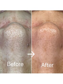 ブルームーン(Blue Moon)/ハイドロ毛穴洗浄&プラズマ